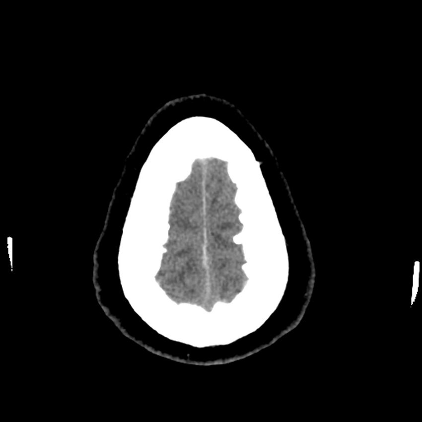Chiasmatic-hypothalamic juvenile pilocytic astrocytoma (Radiopaedia 78533-91237 Axial non-contrast 52).jpg