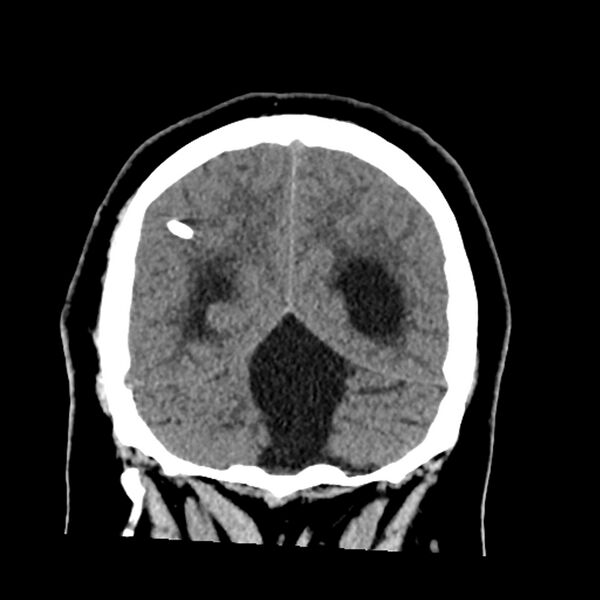 File:Chiasmatic-hypothalamic juvenile pilocytic astrocytoma (Radiopaedia 78533-91237 Coronal non-contrast 55).jpg