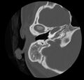 Cholesteatoma (Radiopaedia 20296-20217 bone window 20).jpg