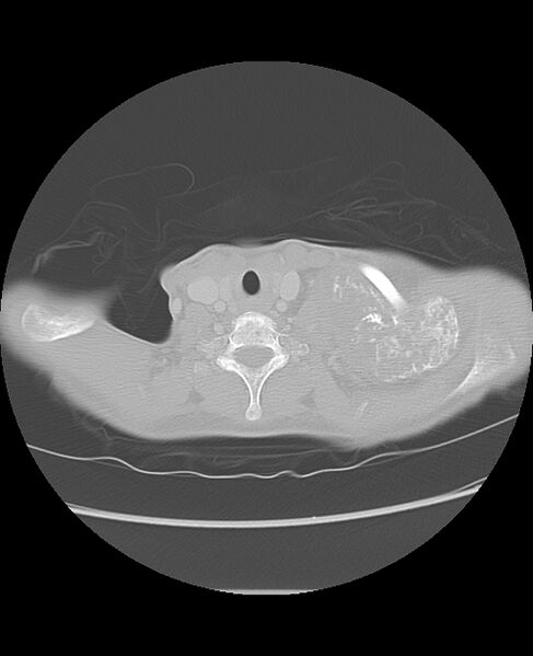 File:Chondrosarcoma (Radiopaedia 79427-92532 Axial lung window 1).jpg