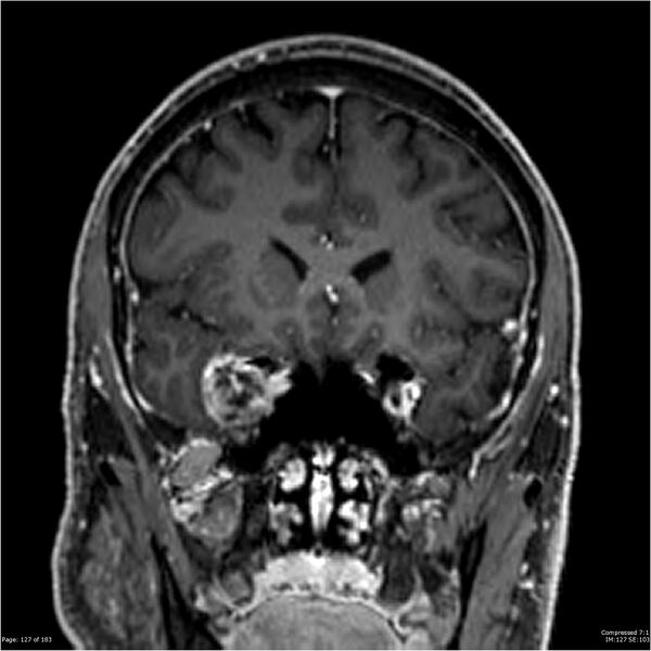 File:Chondrosarcoma of skull base- grade II (Radiopaedia 40948-43654 Coronal T1 C+ 38).jpg