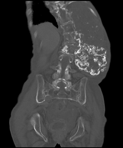 File:Chondrosarcoma of the spine (Radiopaedia 49871-55143 Coronal bone window 9).jpg