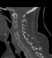 Chordoma (C4 vertebra) (Radiopaedia 47561-52188 Sagittal bone window 42).png
