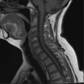 Chordoma (C4 vertebra) (Radiopaedia 47561-52189 Sagittal T1 6).png