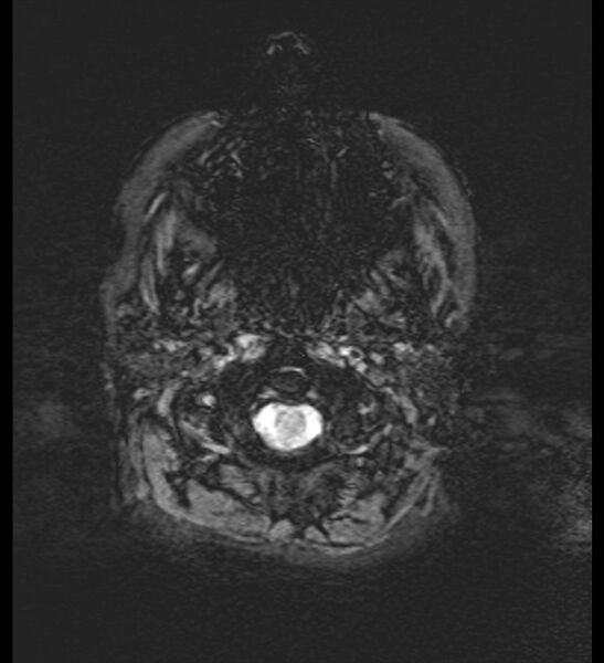 File:Choroid plexus xanthogranuloma (Radiopaedia 91271-108875 Axial SWI 2).jpg