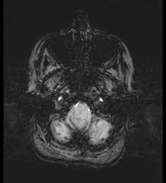 File:Choroid plexus xanthogranuloma (Radiopaedia 91271-108875 Axial SWI 9).jpg