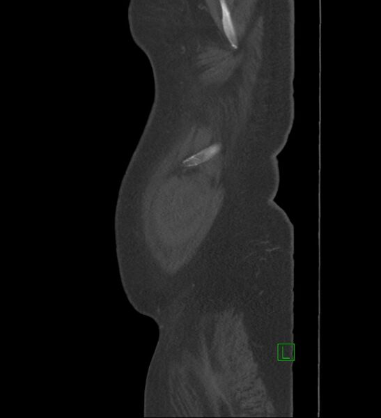File:Chromophobe renal cell carcinoma (Radiopaedia 84239-99519 Sagittal bone window 104).jpg