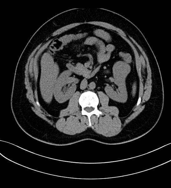 File:Chromophobe renal cell carcinoma (Radiopaedia 84286-99573 Axial non-contrast 22).jpg