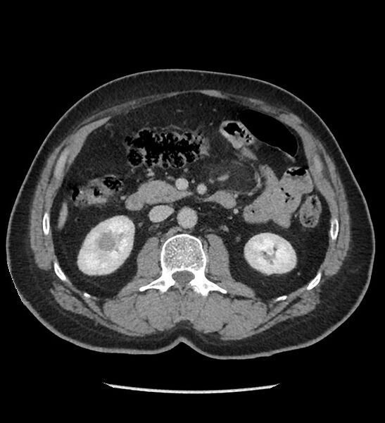 File:Chromophobe renal cell carcinoma (Radiopaedia 86879-103083 C 63).jpg