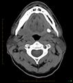 Chronic Submandibular sialolithiasis (Radiopaedia 16880-16606 Axial non-contrast 14).jpg