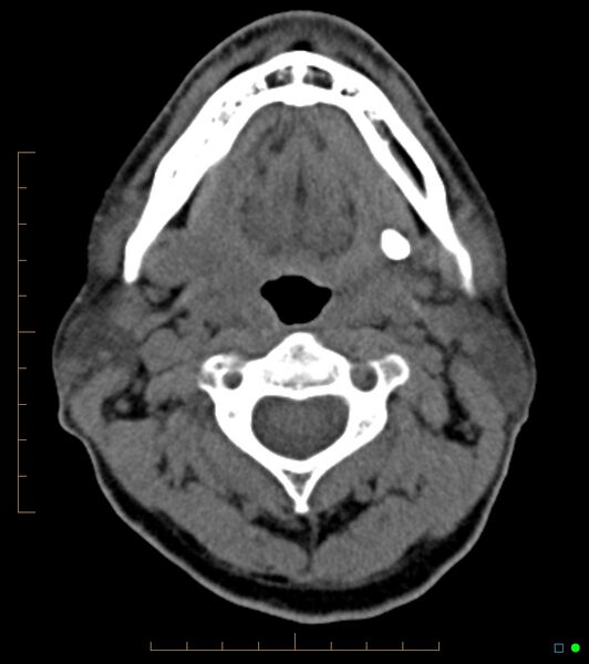 File:Chronic Submandibular sialolithiasis (Radiopaedia 16880-16606 Axial non-contrast 14).jpg