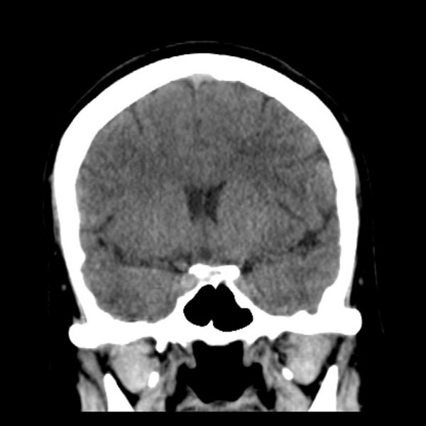 File:Chronic bilateral occipital lobe infarcts (Radiopaedia 31276-31996 Coronal non-contrast 21).jpg