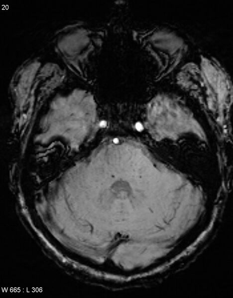 File:Chronic lymphocytic inflammation with pontine perivascular enhancement responsive to steroids (CLIPPERS) (Radiopaedia 37520-39374 Axial SWI 19).jpg