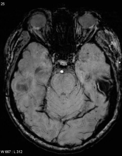 File:Chronic lymphocytic inflammation with pontine perivascular enhancement responsive to steroids (CLIPPERS) (Radiopaedia 37520-39374 Axial SWI 24).jpg