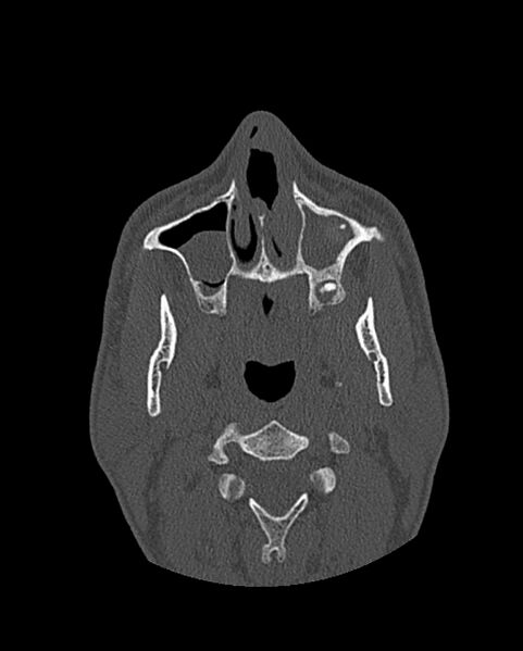 File:Chronic maxillary sinusitis caused by a foreign body (Radiopaedia 58521-65676 Axial bone window 78).jpg