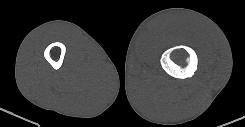 File:Chronic osteomyelitis (with sequestrum) (Radiopaedia 74813-85822 Axial non-contrast 109).jpg
