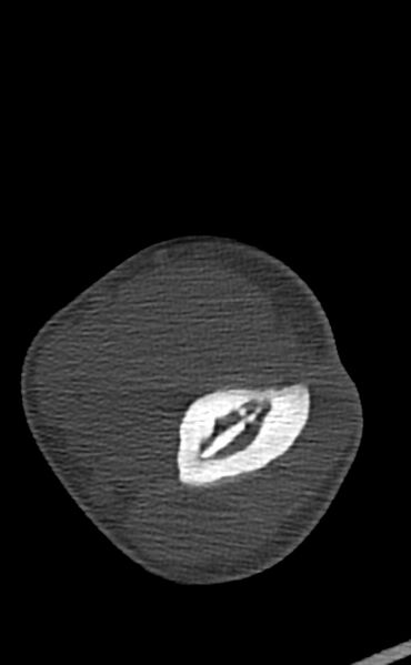 File:Chronic osteomyelitis of the distal humerus (Radiopaedia 78351-90971 Axial bone window 69).jpg