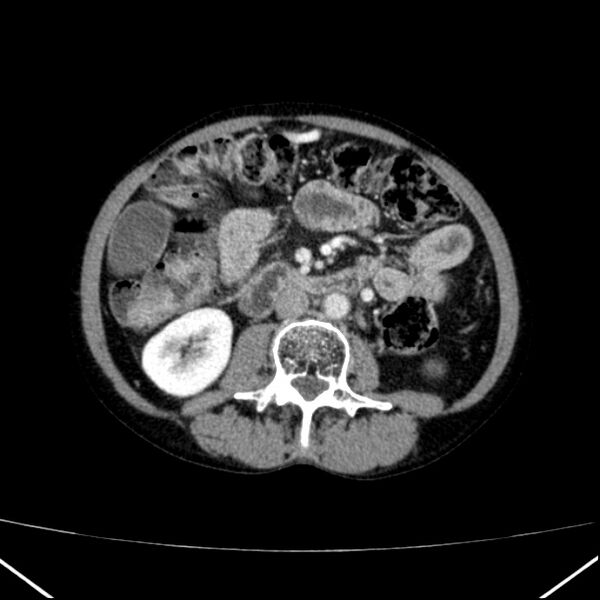 File:Chronic pancreatitis (Radiopaedia 23132-23172 B 31).jpg