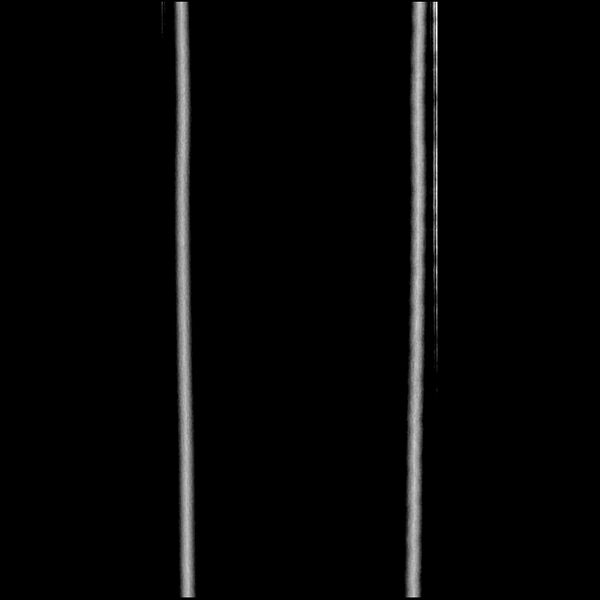 File:Chronic pelviureteric junction obstruction (Radiopaedia 90643-108052 B 48).jpg