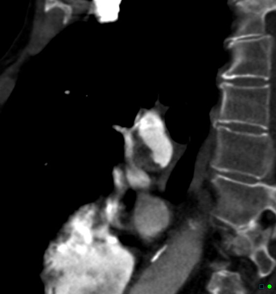File:Chronic pulmonary embolism (Radiopaedia 17943-17702 Sagittal C+ CTPA 34).jpg