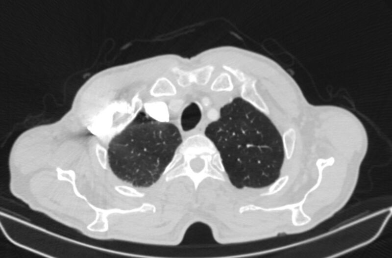 File:Chronic pulmonary embolism (Radiopaedia 91241-108843 Axial lung window 10).jpg