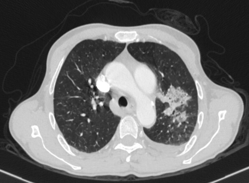 File:Chronic pulmonary embolism with bubbly consolidation (Radiopaedia 91248-108850 Axial lung window 48).jpg