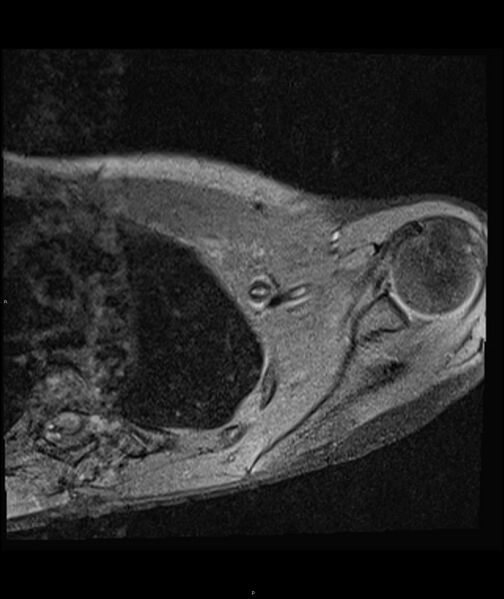 File:Chronic reactive multifocal osteomyelitis (CRMO) - clavicle (Radiopaedia 56406-63071 Axial T1 fat sat 15).jpg