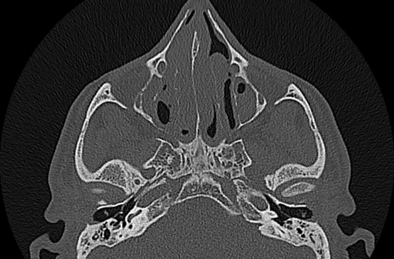 File:Chronic rhinosinusitis (Radiopaedia 65079-74075 Axial bone window 36).jpg