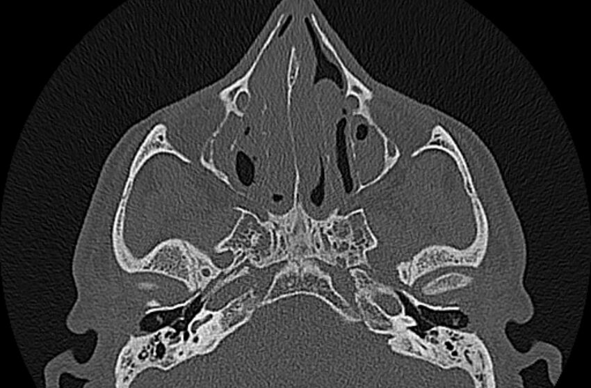Chronic rhinosinusitis (Radiopaedia 65079-74075 Axial bone window 36).jpg