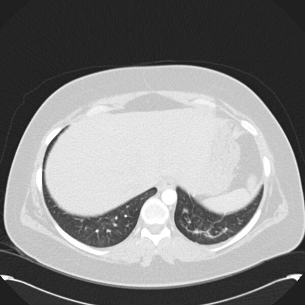 File:Chronic thromboembolic pulmonary hypertension (CTEPH) (Radiopaedia 74597-85531 Axial lung window 44).jpg