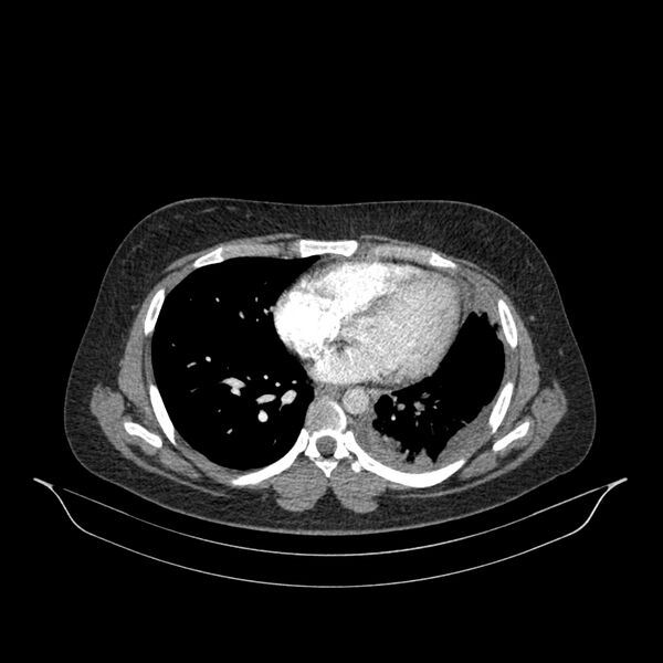 File:Chronic thromboembolic pulmonary hypertension (CTEPH) (Radiopaedia 74597-85532 Axial C+ CTPA 67).jpg