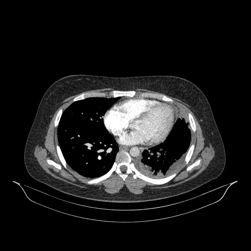 Chronic thromboembolic pulmonary hypertension (CTEPH) (Radiopaedia 74597-85532 Axial C+ CTPA 67).jpg