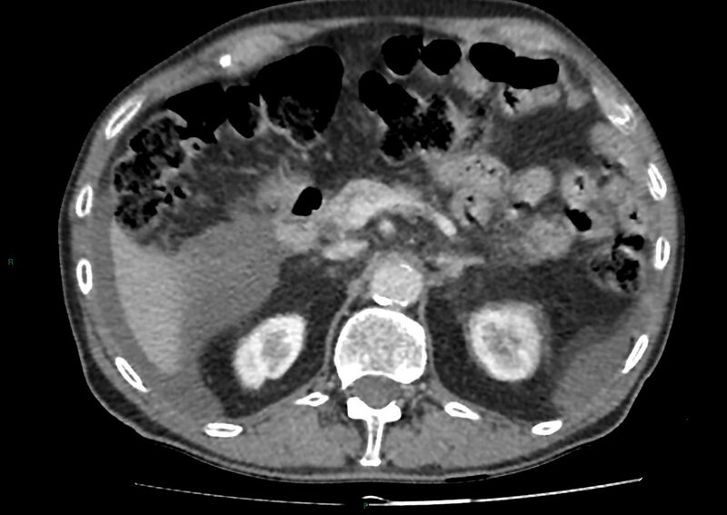 File:Closed loop small bowel obstruction with ischemia (Radiopaedia 84180-99456 A 35).jpg