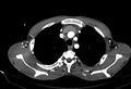 Coarctation of aorta with aortic valve stenosis (Radiopaedia 70463-80574 A 20).jpg