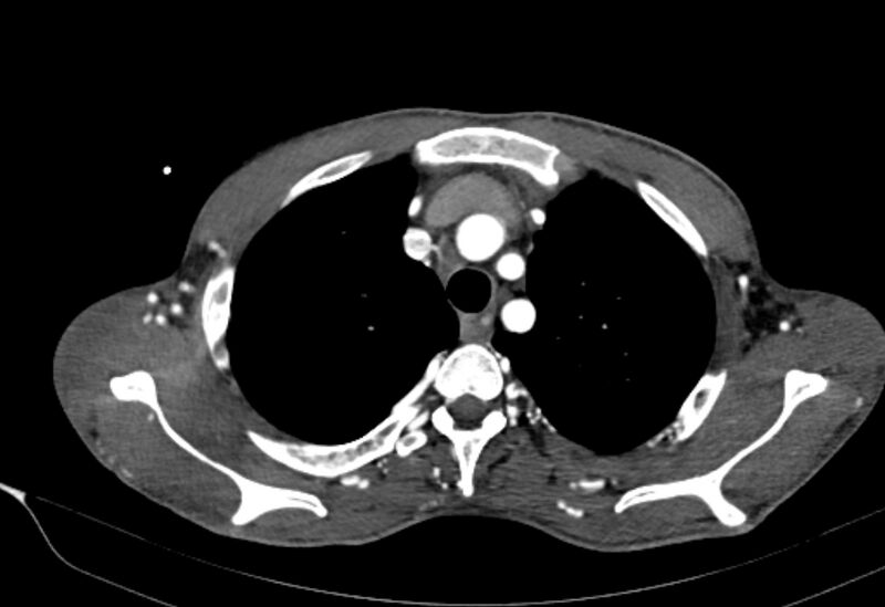 File:Coarctation of aorta with aortic valve stenosis (Radiopaedia 70463-80574 A 20).jpg