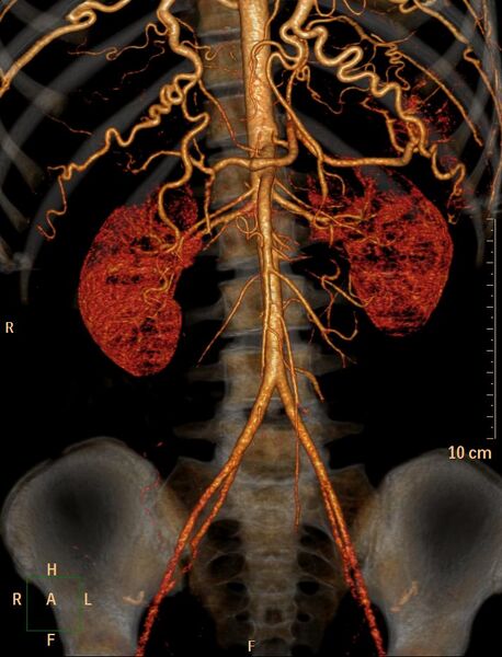 File:Coarctation of the aorta (Radiopaedia 27458-27657 3D 9).jpg