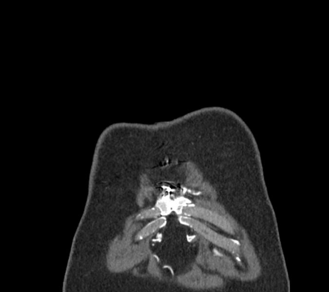 File:Coarctation of the aorta (Radiopaedia 53752-59822 B 1).jpg