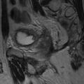Colonic fistula (Radiopaedia 16047-15708 Sagittal T2 2).jpg