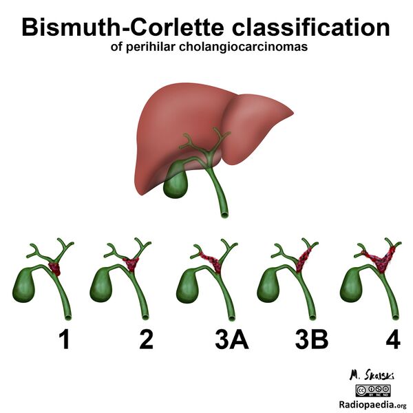 File:Diagram - Bismuth-Corlette classification of perihilar cholangiocarcinoma (Radiopaedia 20924).jpg