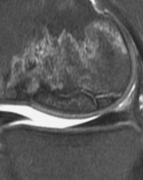 File:Distal femoral avascular necrosis (Radiopaedia 36034).jpg