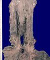 Esophageal rupture (gross pathology) (Radiopaedia 29964).jpg