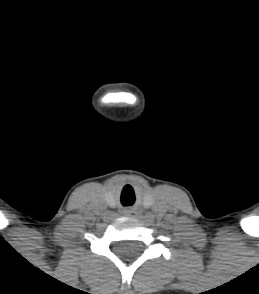 File:Nasoorbitoethmoid fracture (Radiopaedia 90044-107205 Axial non-contrast 9).jpg