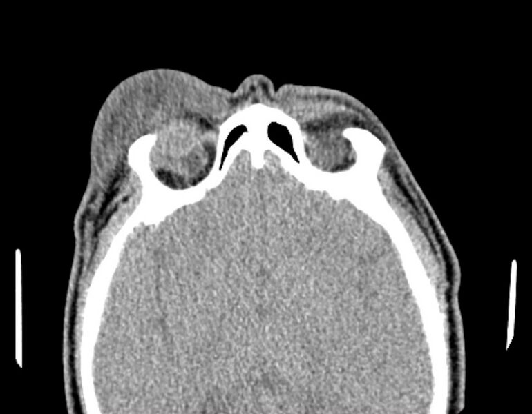 File:Necrobiotic xanthogranuloma- face (Radiopaedia 29549-30052 Axial C+ delayed 1).jpg