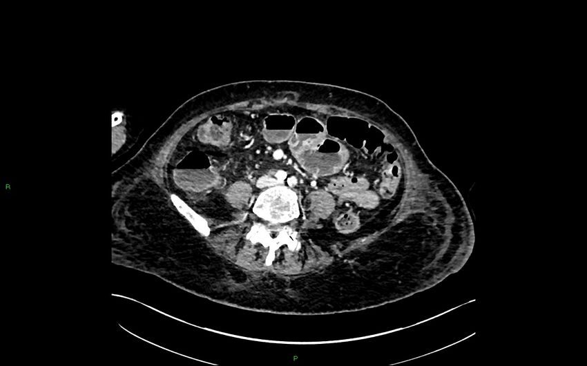 Neo-terminal ileal stricture (Crohn disease) (Radiopaedia 33790-34948 A 272).jpg