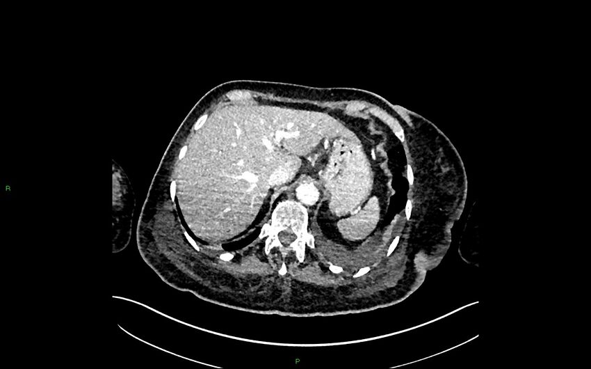 Neo-terminal ileal stricture (Crohn disease) (Radiopaedia 33790-34948 A 74).jpg