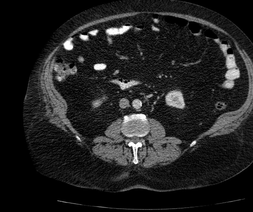Nephroptosis with inguinal hernia containing perirenal fat (Radiopaedia 56632-63391 C 175).jpg