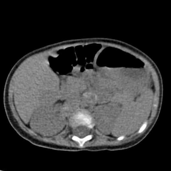 File:Neuroblastoma with skull metastases (Radiopaedia 30326-30960 Axial non-contrast 24).jpg