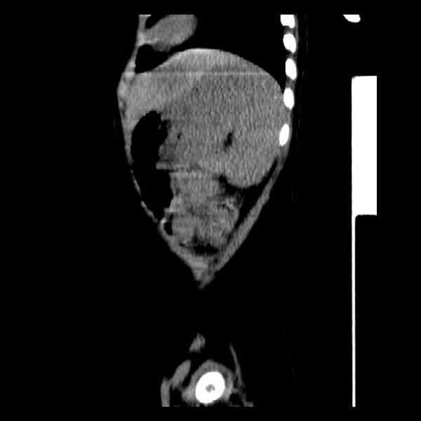 File:Neuroblastoma with skull metastases (Radiopaedia 30326-30960 B 39).jpg