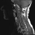 Neurofibromatosis type 1 (Radiopaedia 80355-93740 Sagittal T1 8).jpg