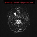 Neuroglial cyst (Radiopaedia 10713-11184 Axial DWI 21).jpg